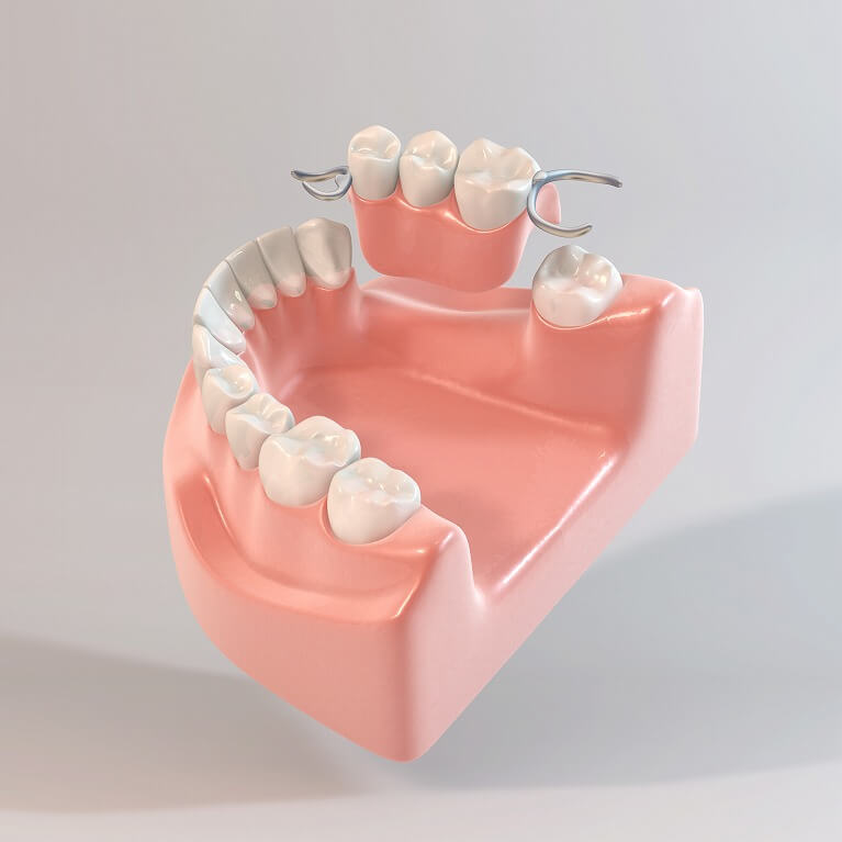 歯科用プラスチック