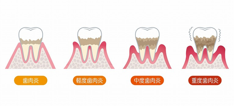 歯周病の進行状態