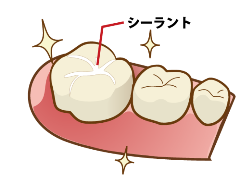 シーラント|うぐいす歯科
