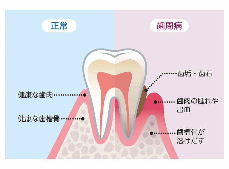 歯周病とは|うぐいす歯科