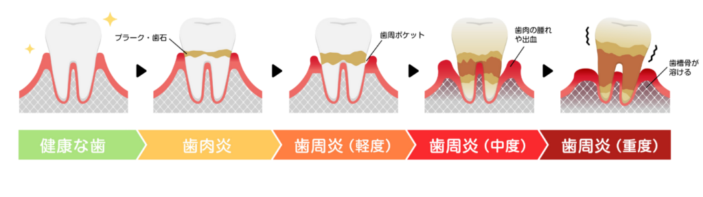 歯周病の進行状態|うぐいす歯科