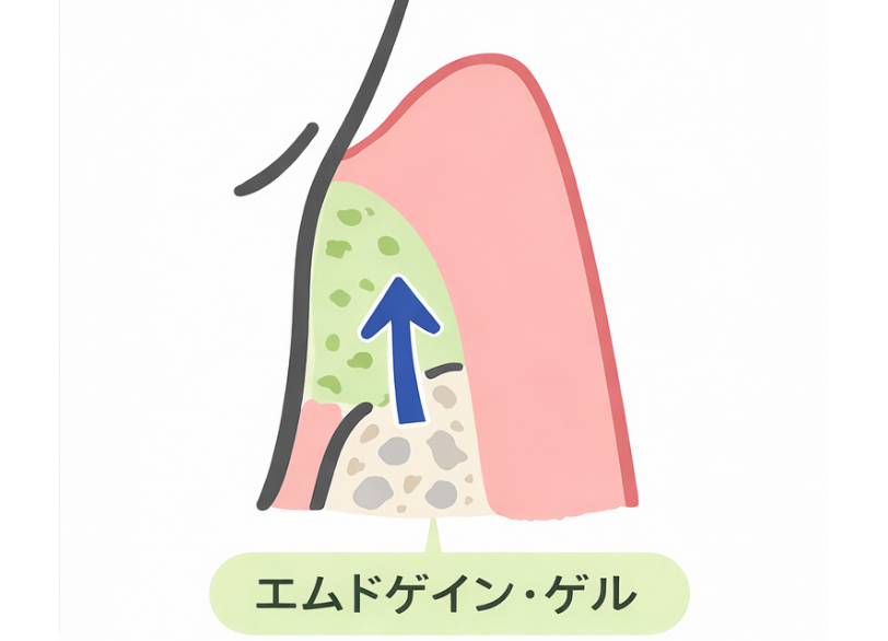 エムドゲイン|うぐいす歯科