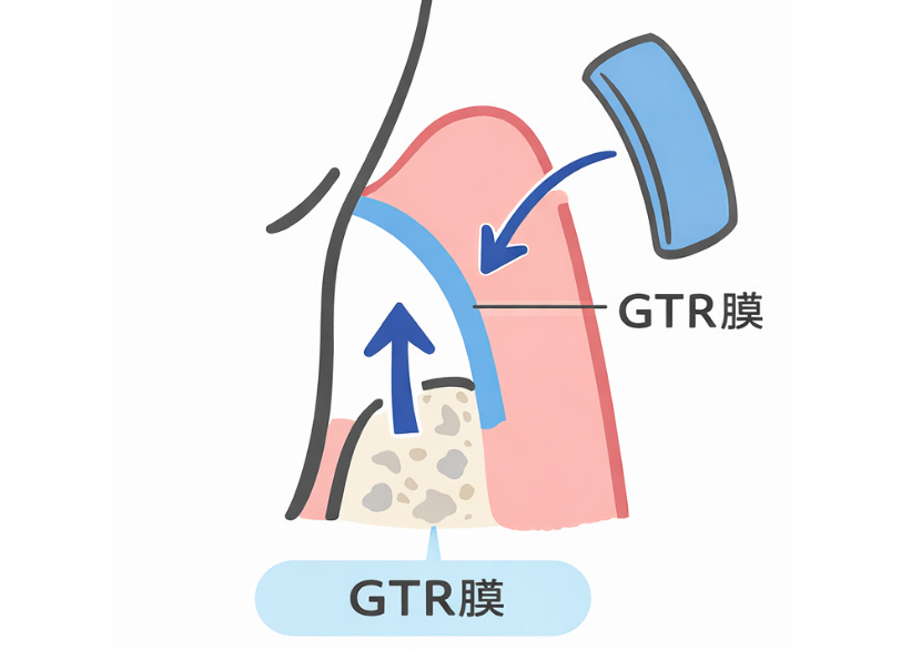 GTR法|うぐいす歯科