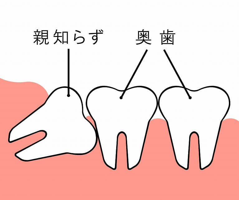 「親知らず」について|うぐいす歯科